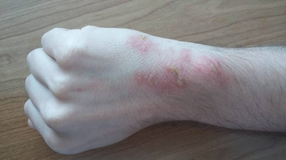 Opekline z navadnim rebrincem